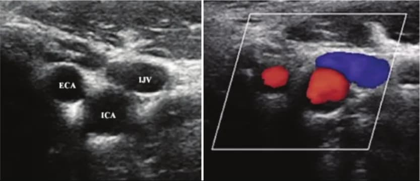 Can thiệp nội mạch điều trị tắc động mạch vùng dưới gối