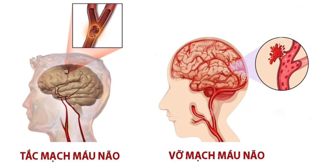 Khả năng hồi phục sau khi tai biến mạch máu não nặng
