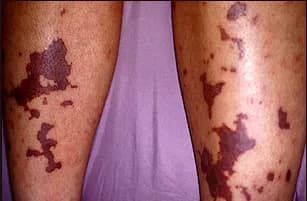 Đông máu nội mạch lan tỏa: Triệu chứng và cách điều trị