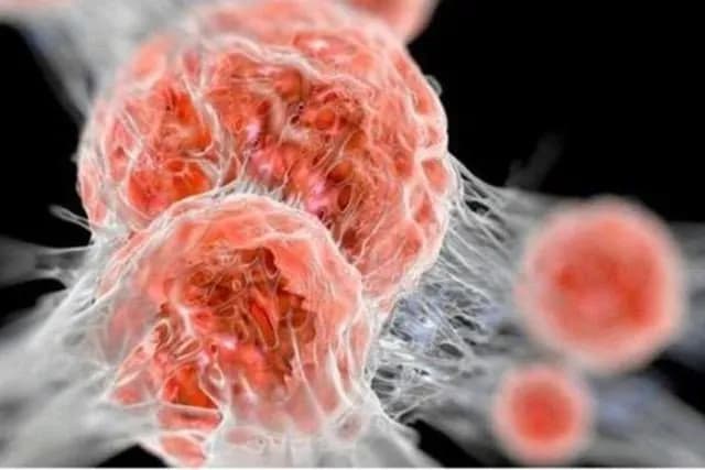 Các khối u lành tính ở tim: Những điều cần biết