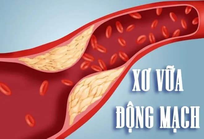 Dấu hiệu cảnh báo phình động mạch chủ ngực
