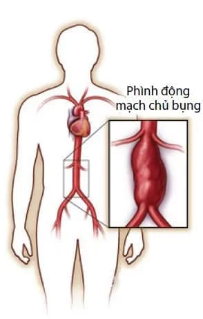 Dấu hiệu cảnh báo phình động mạch chủ bụng