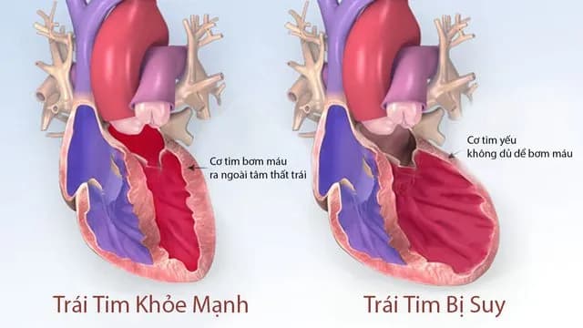 Suy tim - Đích đến cuối cùng của các bệnh tim mạch và một số bệnh khác