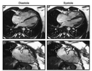 Ứng dụng của cộng hưởng từ tim mạch trong chẩn đoán suy tim