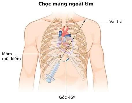 Cấp cứu chèn ép tim cấp