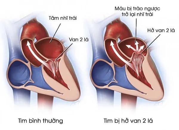 Suy tim cấp và phù phổi cấp do tim