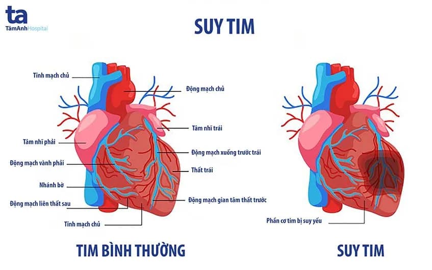 Suy tim: Nguyên nhân, triệu chứng và phương pháp điều trị