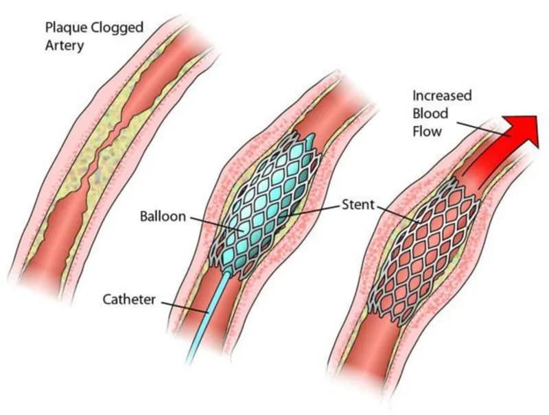 Phình động mạch chủ: Đặt stent graft trong trường hợp nào?