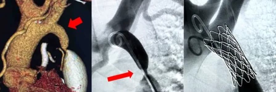 Nong hẹp eo động mạch chủ