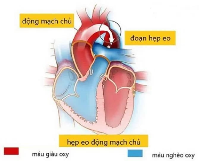Nong hẹp eo động mạch chủ