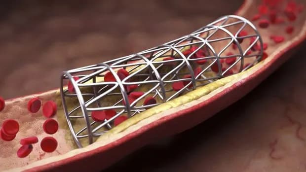 Độ bền của stent mạch vành