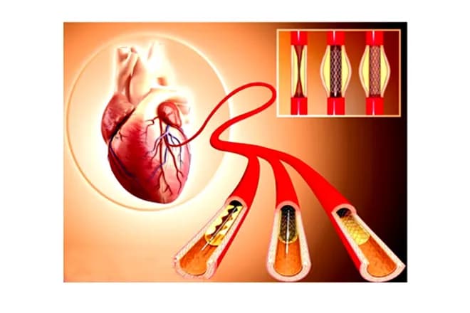 Cảnh giác biến chứng tắc mạch sau đặt stent