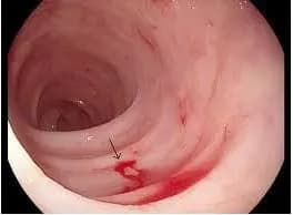 Bệnh mạch máu tinh bột là gì?