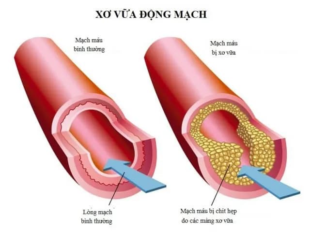 Xơ cứng động mạch hay xơ vữa động mạch?