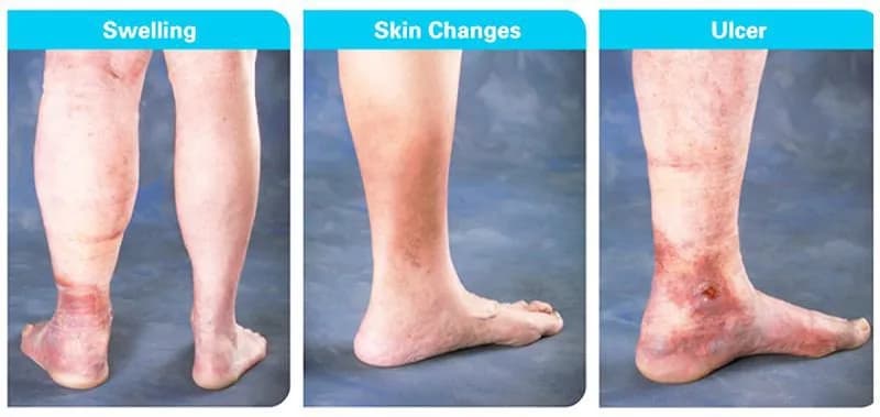 Sau khi bị huyết khối tĩnh mạch: Cần xử trí thế nào?