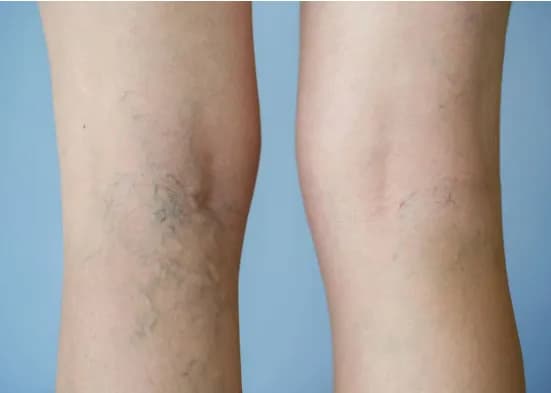 Yếu tố nguy cơ gây huyết khối tĩnh mạch sâu và tắc mạch phổi