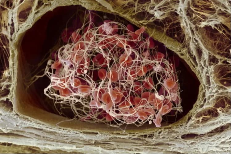 Yếu tố nguy cơ gây huyết khối tĩnh mạch sâu và tắc mạch phổi