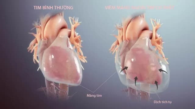 Tăng Troponin huyết thanh ngoài hội chứng vành cấp
