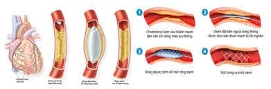Chỉ định của nong và đặt stent động mạch vành