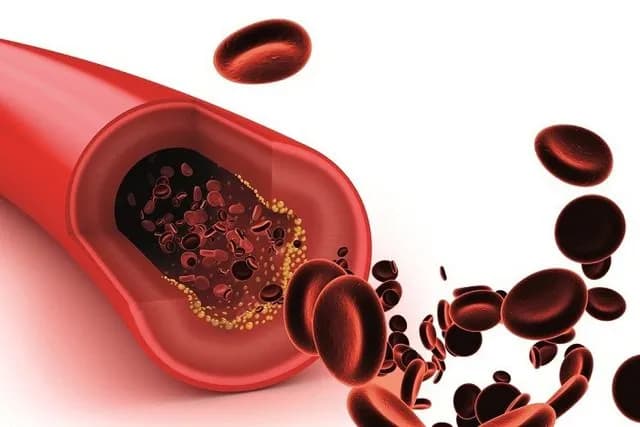 Thiếu máu cơ tim thầm lặng