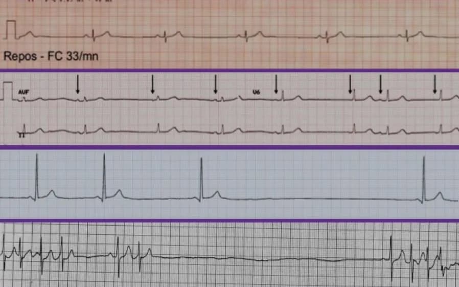 Những biến chứng nguy hiểm của bệnh mạch vành cấp