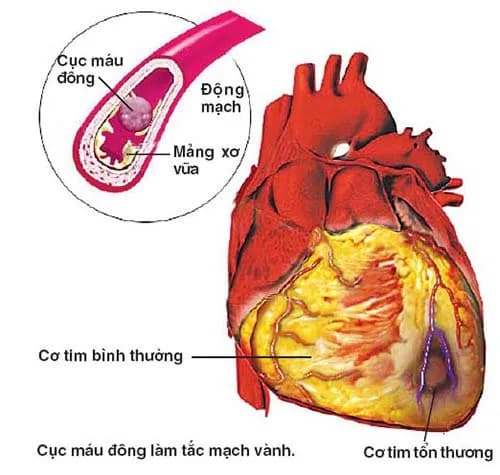 Stent động mạch vành tồn tại bao lâu trong cơ thể