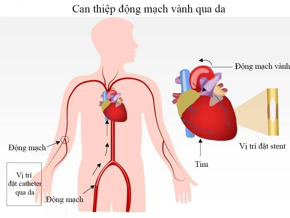 Ưu điểm của kỹ thuật chụp, nong và đặt stent động mạch vành