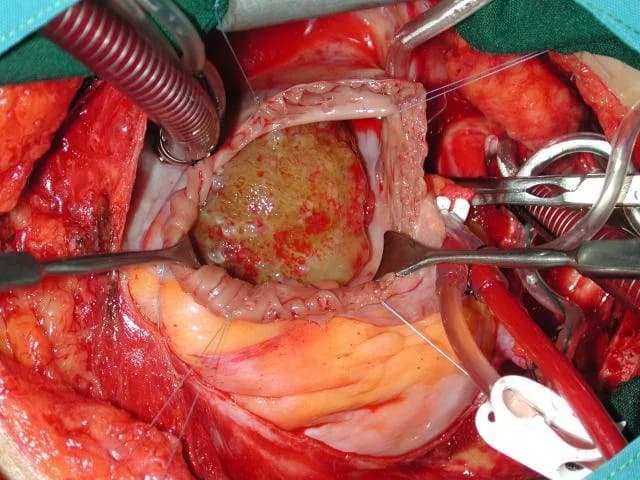 Thông tin về bệnh học u nhầy nhĩ trái