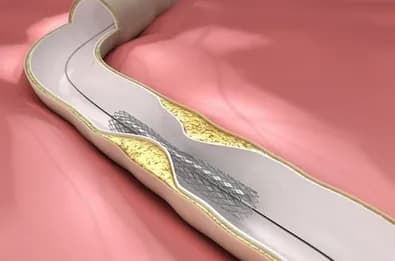 Tuổi thọ có stent động mạch vành