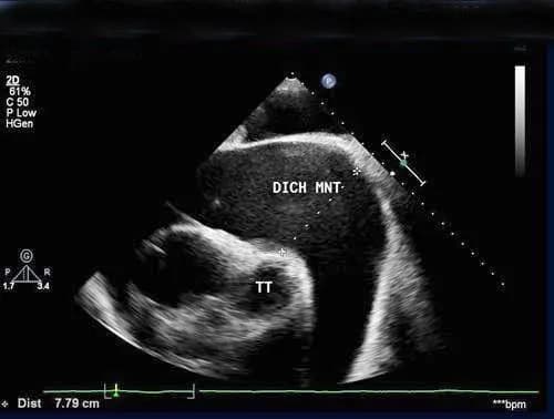 Siêu âm Doppler đánh giá biến chứng sau nhồi máu cơ tim