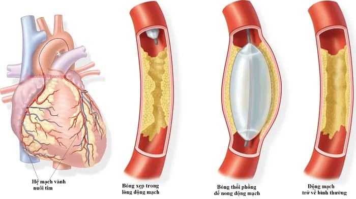 Sử dụng tiêu sợi huyết trong nhồi máu cơ tim cấp