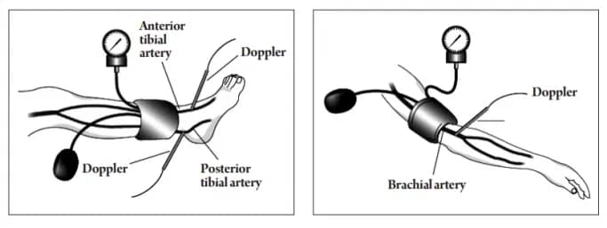 Tìm hiểu chỉ số huyết áp cổ chân - cánh tay ( ABI)