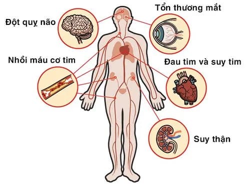 Thế nào là cao huyết áp vô căn nguyên phát?