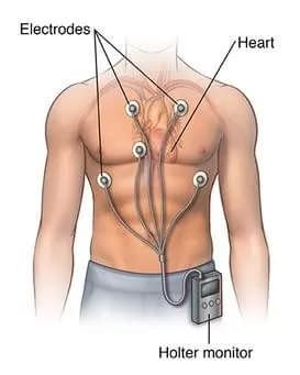 Holter điện tâm đồ