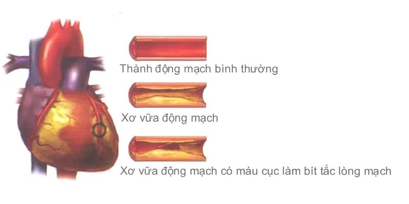 Xơ vữa động mạch