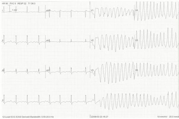 Hội chứng xoắn đỉnh là gì?