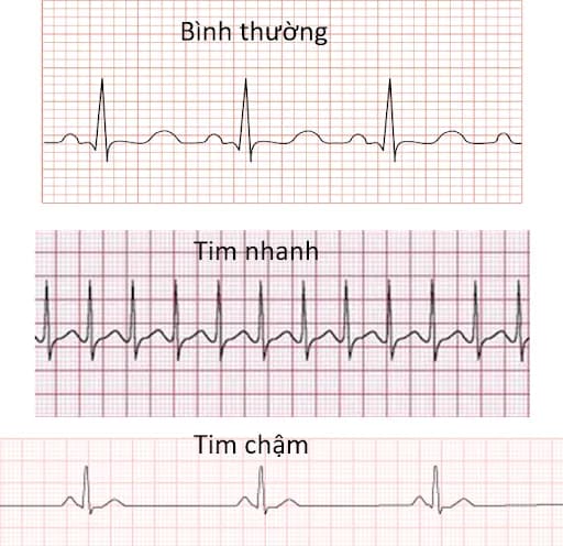Nhịp tim nguy hiểm: Nhịp nhanh, nhịp chậm