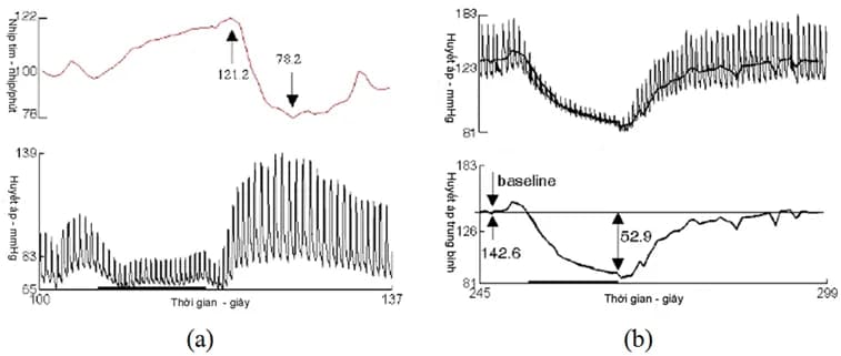 Test đáp ứng nhịp tim với nghiệm pháp Valsalva
