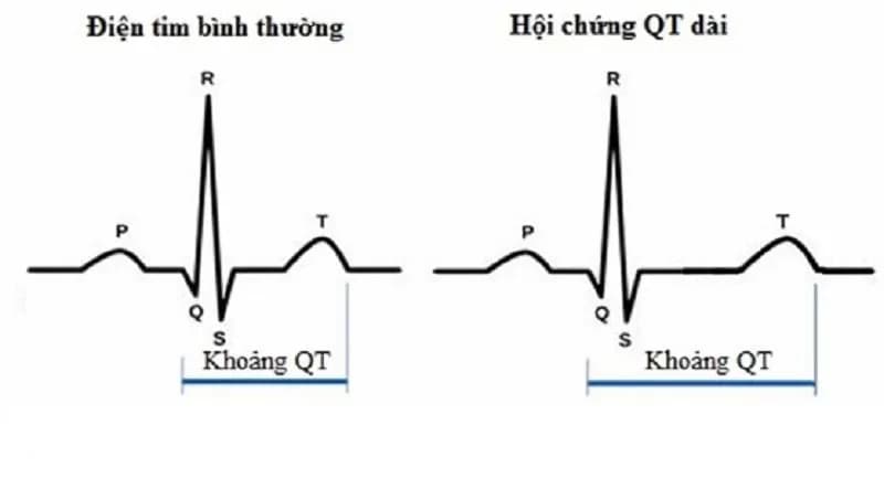 Hội chứng QT dài: Nguyên nhân và triệu chứng