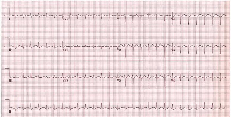 Nhịp nhanh xoang – Nguy hiểm hay không nguy hiểm?