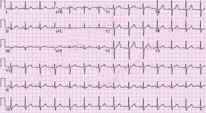 Nhịp nhanh xoang – Nguy hiểm hay không nguy hiểm?