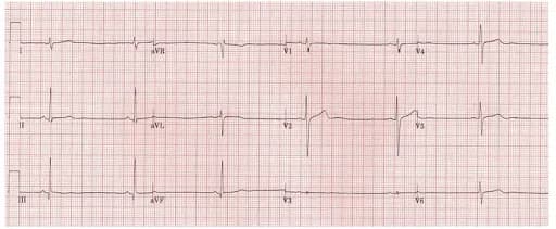 Đặt máy tạo nhịp tạm thời cấp cứu bệnh nhân tim mạch