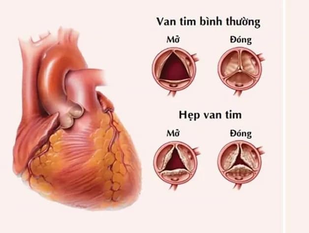 Thay van tim được chỉ định trong trường hợp nào?