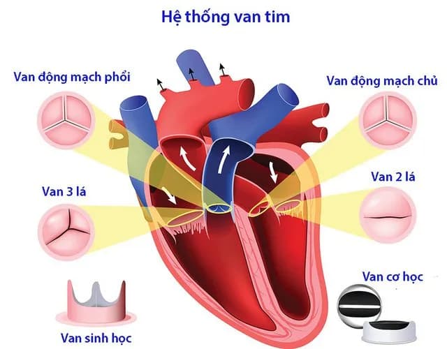 Vai trò của siêu âm tim trong chẩn đoán bệnh van tim
