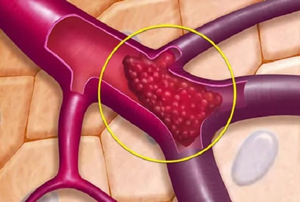 Kết dính tiểu cầu và nguy cơ huyết khối