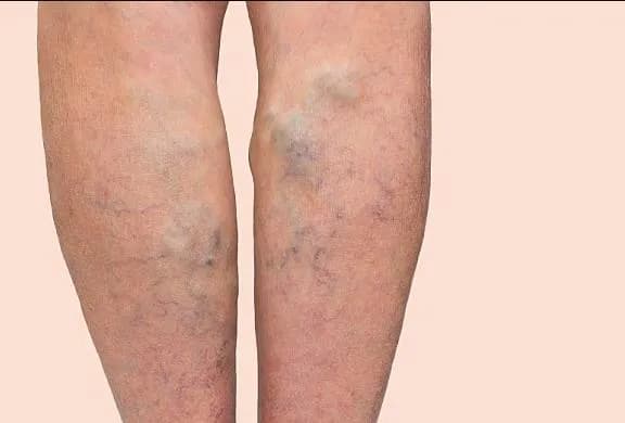 Huyết khối tĩnh mạch sâu chi dưới: Biện pháp điều trị duy trì sớm