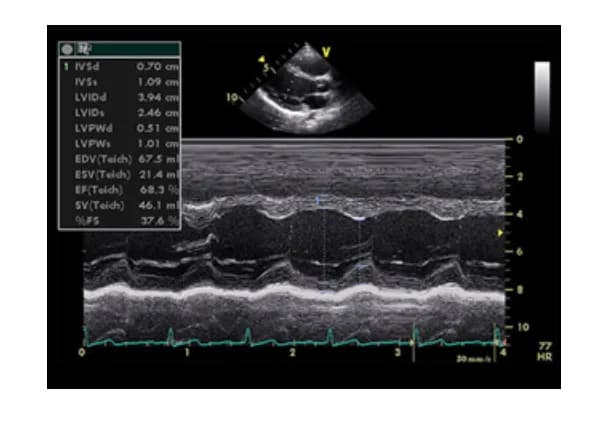 Các kiểu siêu âm tim