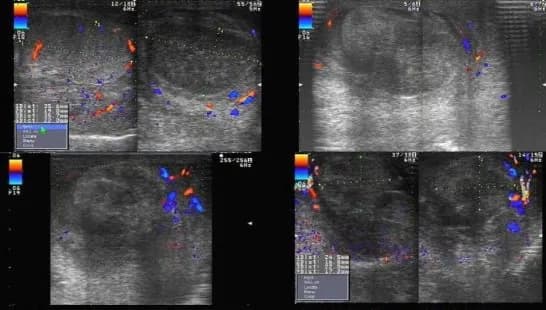 Hình ảnh xoắn tinh hoàn trên siêu âm Doppler màu