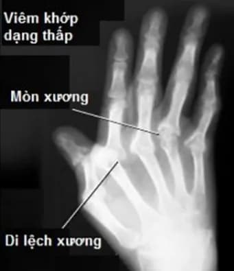 Chỉ định của siêu âm tim qua thực quản