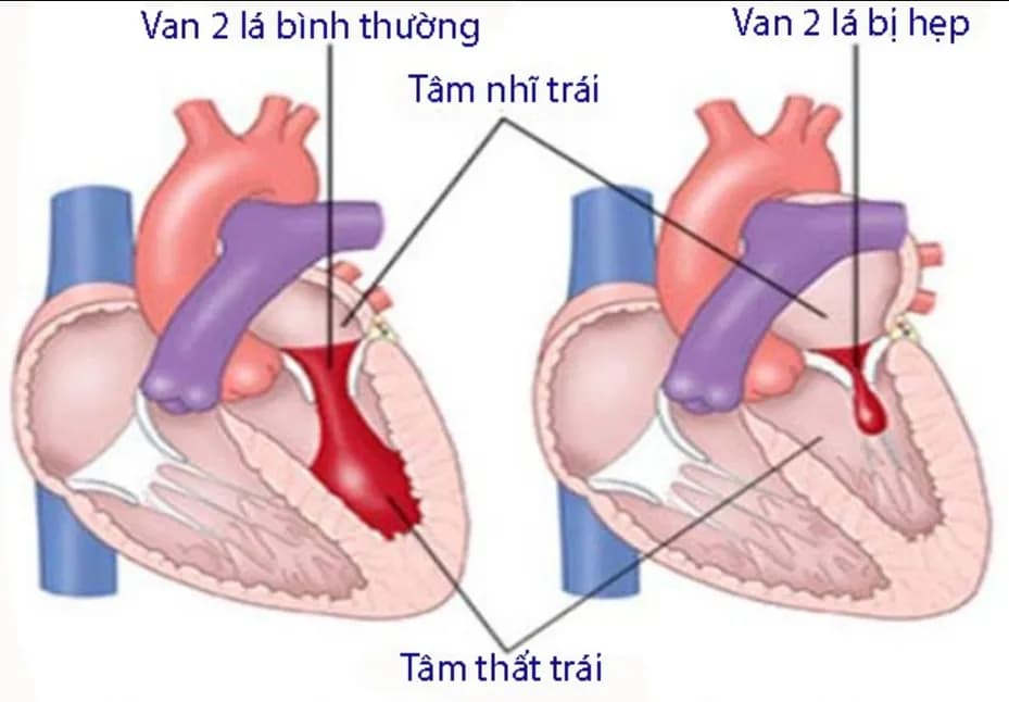 Vai trò của siêu âm tim trong phẫu thuật tim